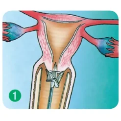 BALAI ENDOCERVICAL