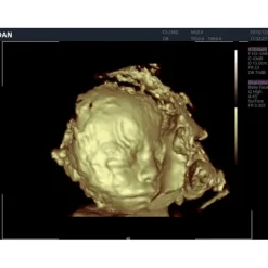 ECHOGRAPHE COULEUR 3D/4D ACLLRAIX LX8 DOPPLER COULEUR EDAN - avec 1 sonde