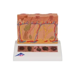 MODÈLE DE CANCER DE LA PEAU AGRANDI 8 FOIS 3B SCIENTIFIC