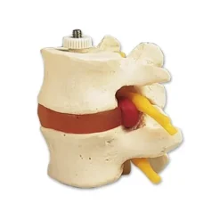 VERTÈBRES LOMBAIRES AVEC PROLAPSUS DISCAL SUR SUPPORT 3B SCIENTIFIC - modèle anatomique