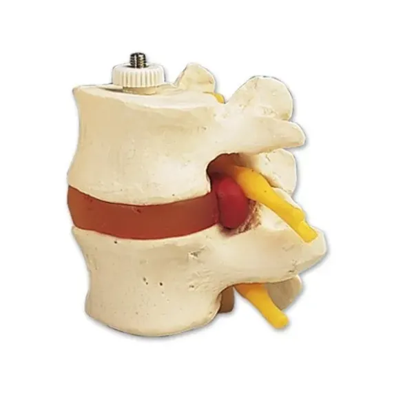 VERTÈBRES LOMBAIRES AVEC PROLAPSUS DISCAL SUR SUPPORT 3B SCIENTIFIC - modèle anatomique
