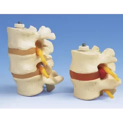 VERTÈBRES LOMBAIRES AVEC PROLAPSUS DISCAL SUR SUPPORT 3B SCIENTIFIC - modèle anatomique